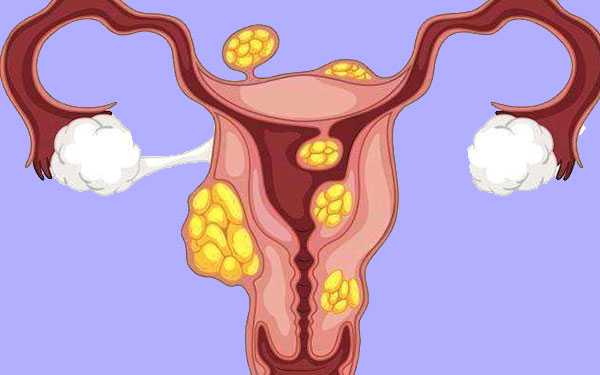 早衰供卵成功率_我的供卵试管婴儿_子宫肌瘤会导致女性不孕,若月经量多就得小