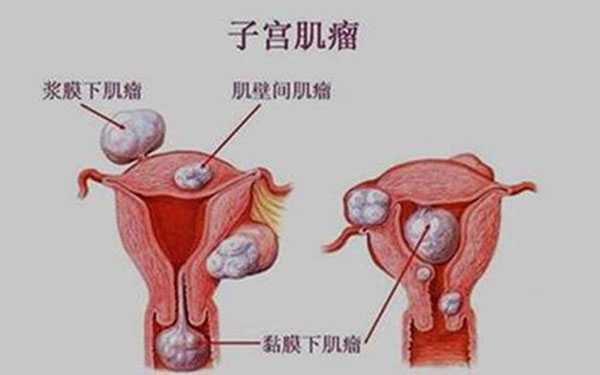 早衰供卵成功率_我的供卵试管婴儿_子宫肌瘤会导致女性不孕,若月经量多就得小